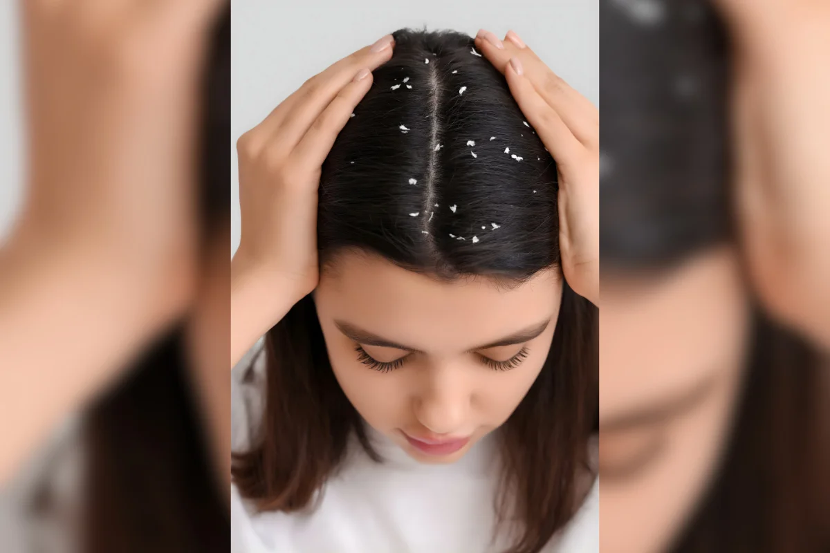 Dandruff & Fungal Infections