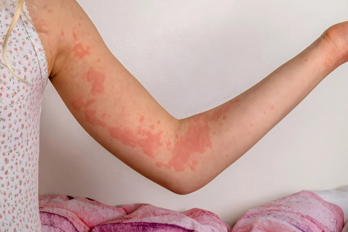 Skin Allergy, Rashes & Urticaria