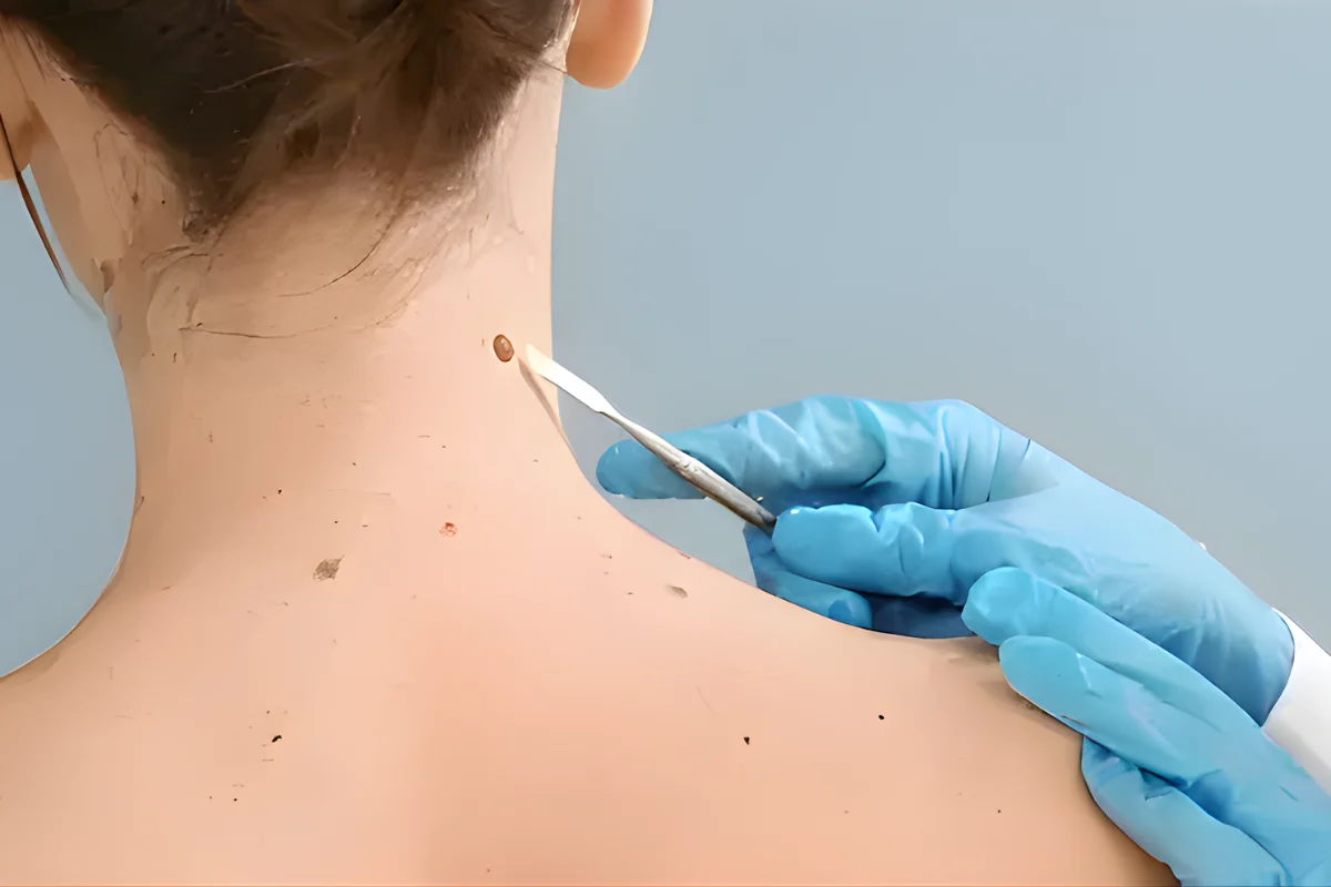   Wart, Mole & Skin Tag Removal